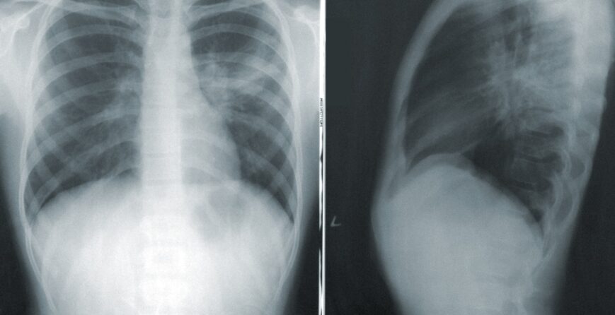 puede-quedar-dano-pulmonar